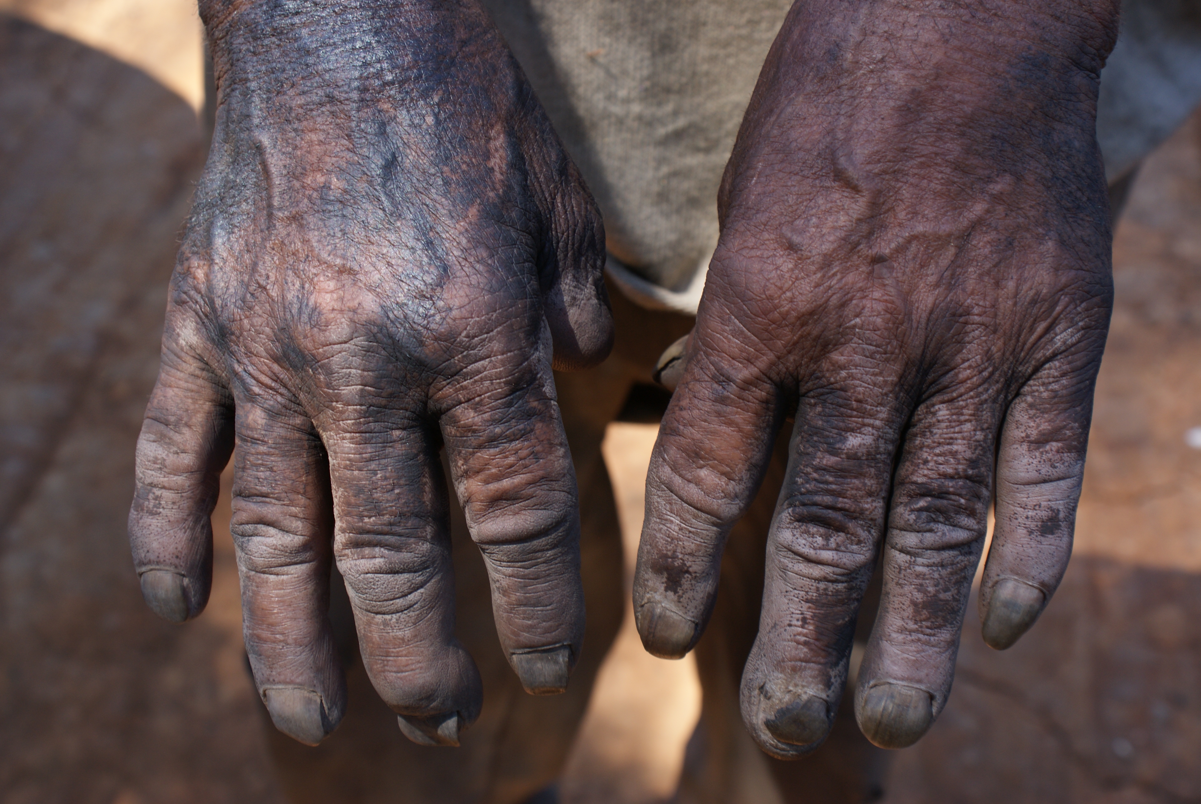 As mãos, negras de pele e de carvão, de um dos trabalhadores resgatados no interior paulista