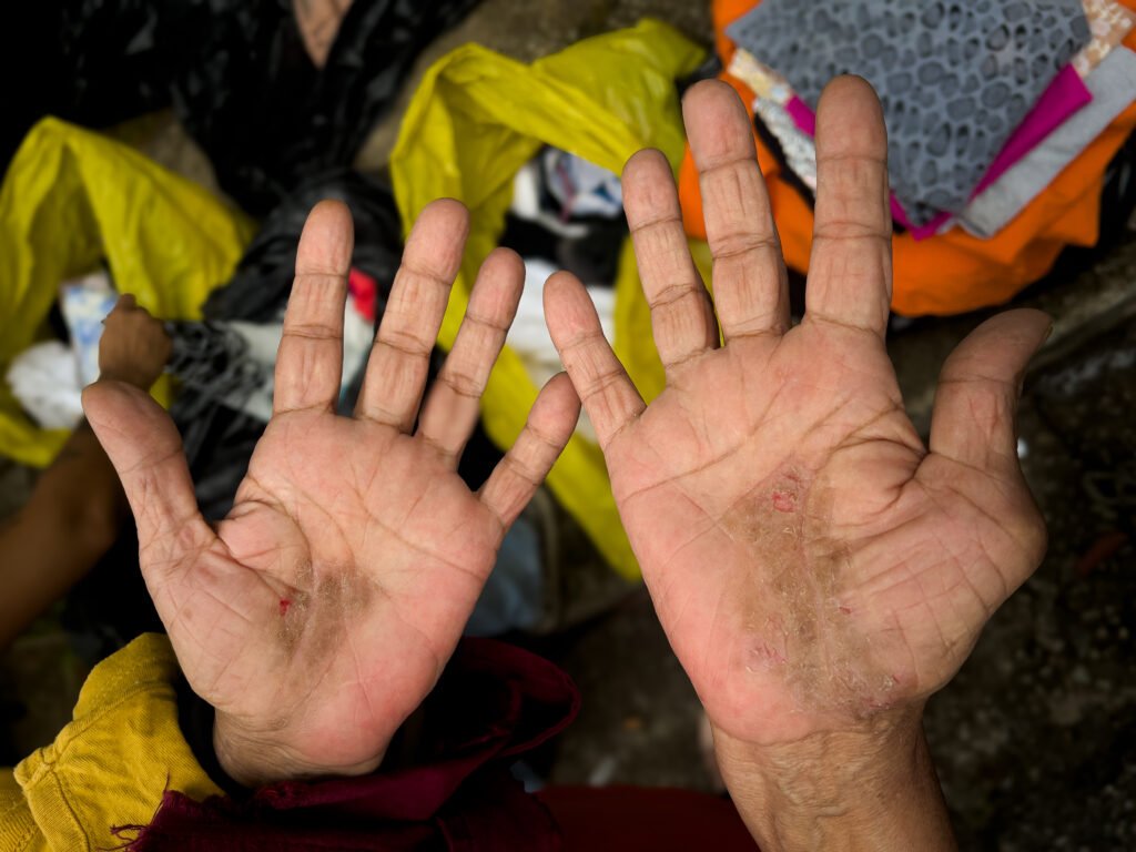 Idosa mostra as mãos machucadas por lavar roupas de companheiras do centro de detenção do Butantã, na capital paulista; ela recorreu ao trabalho informal para sustentar necessidades básicas (Foto: Mariana Rosetti/Repórter Brasil)