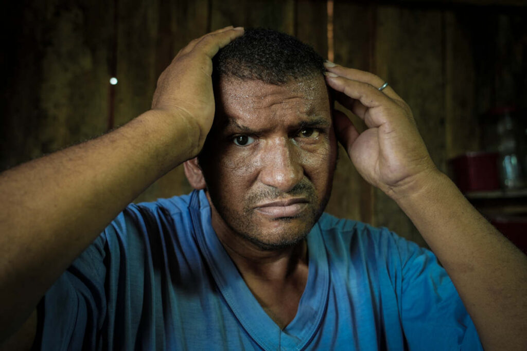 Zé Carlos mostra com as mãos os locais que mais doem em sua cabeça por causa da bala alojada atrás do olho direito há 30 anos (Foto: Fernando Martinho/Repórter Brasil)