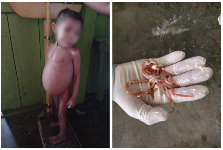 Entre 2019 e 2022, 420 crianças com menos de cinco anos morreram na TI Yanomami por causas evitáveis, como malária, desnutrição e verminoses (Foto: Reprodução/MPF)